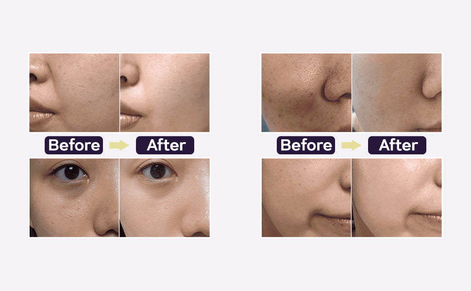 Before and after comparison of skin treatment on a person's face.